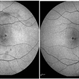 Macular Telangiectasia Type 2 Macular Telangiectasia Type 2